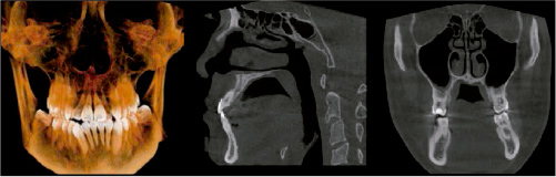 Escáner maxilofacial 3D con campo de visión 13x15 centímetros