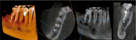 Escáner maxilofacial 3D con campo de visión 5x5 centímetros