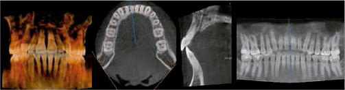 Escáner maxilofacial 3D con campo de visión 6x8 centímetros
