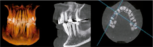 Escáner maxilofacial 3D con campo de visión 8x8 centímetros